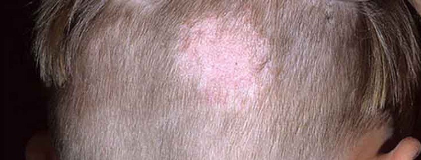 Scalp Ringworm